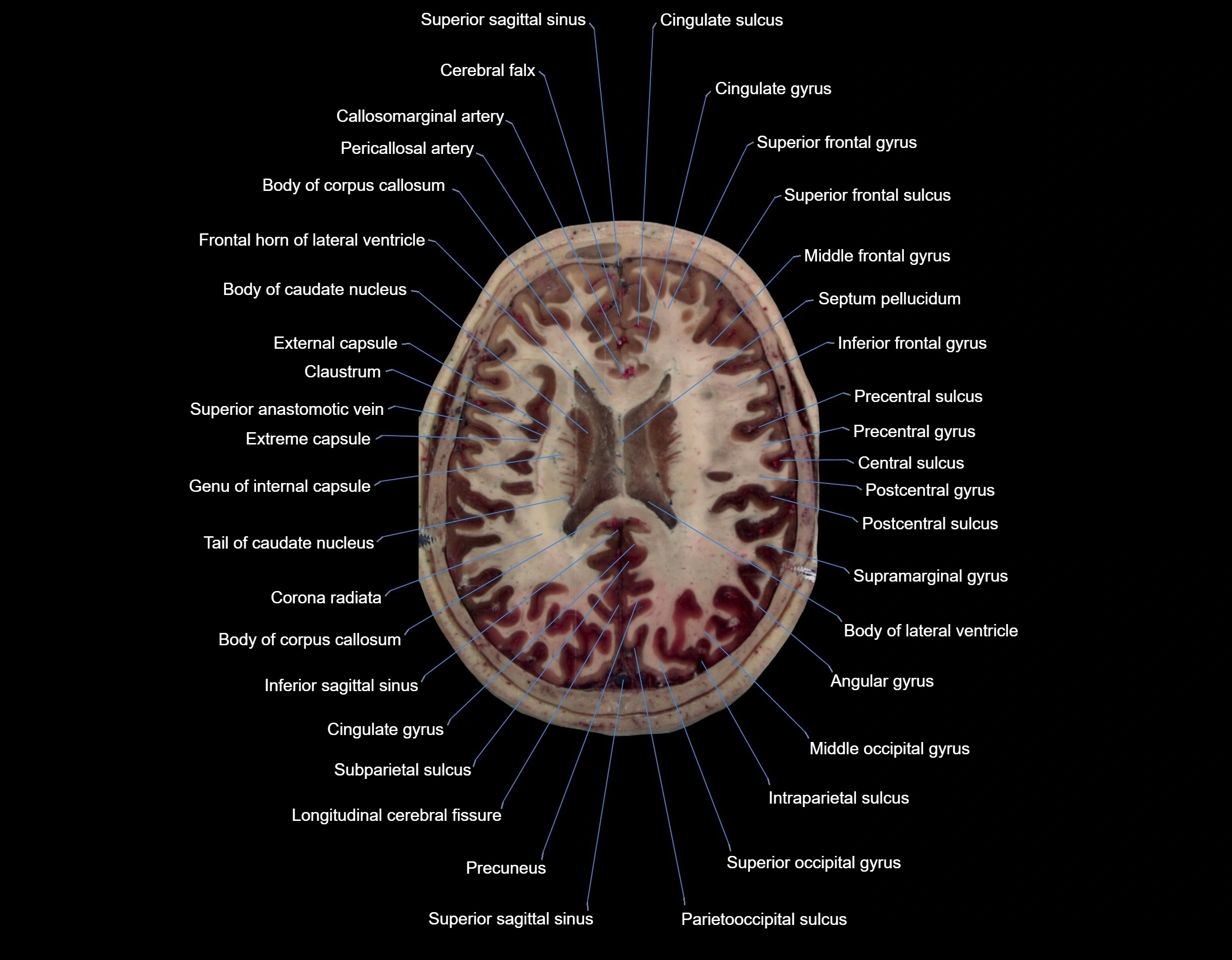MRI Brain axial cross sectional radiology anatomy 3T image  -img-000050.webp
